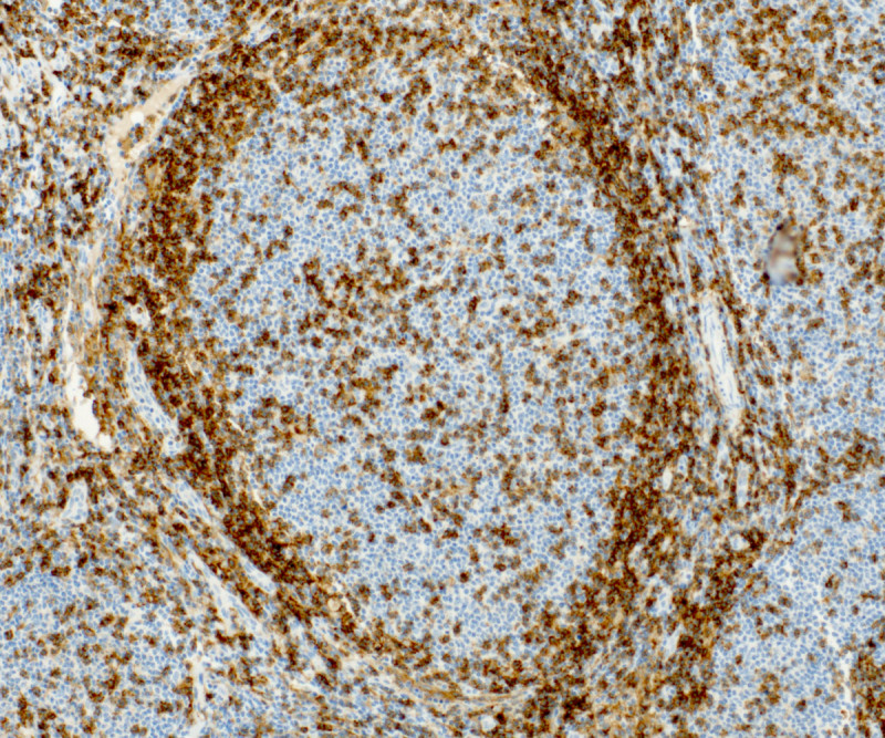 Molekula, která řídí agresivitu nádoru mízních uzlin